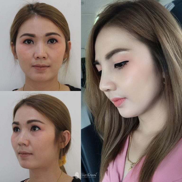 เสริมจมูกที่ไหนดี เจ็บไหม กี่วันล้างหน้าได้ ปี 2023 - lelux เสริมจมูกที่ไหนดี เจ็บไหม กี่วันล้างหน้าได้ ปี 2023 - Lelux