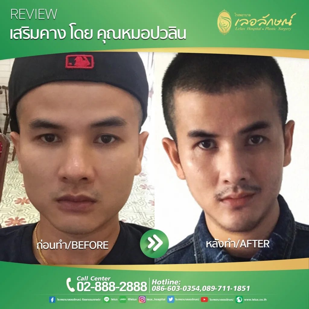 Befor&After ปี 2023 - Lelux