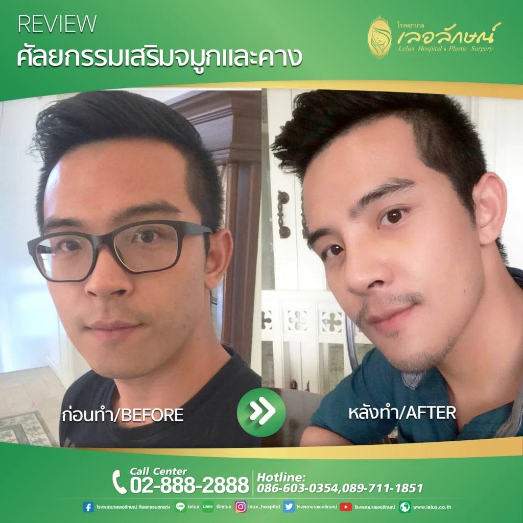 befor&After ปี 2023 - lelux Befor&After ปี 2023 - Lelux